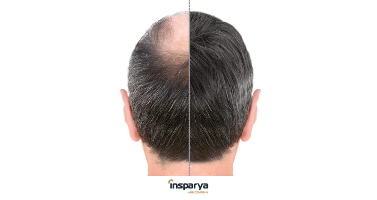 In Cosa Consiste Il Trapianto Di Capelli Insparya Hair Group