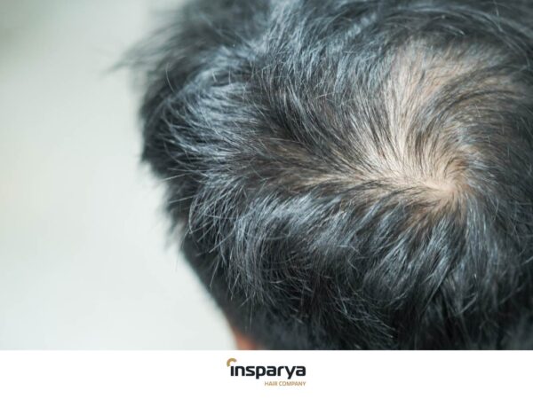 Alopecia Androgenetica