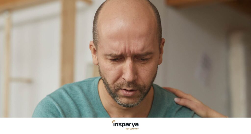 Alopecia areata: sintomi, cause e trattamenti