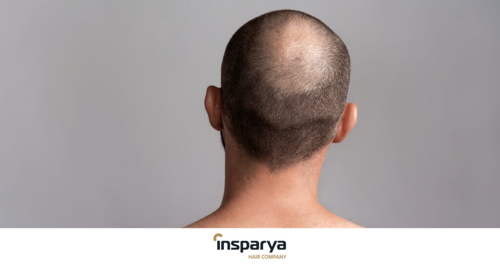 Come trattare l'alopecia sulla corona