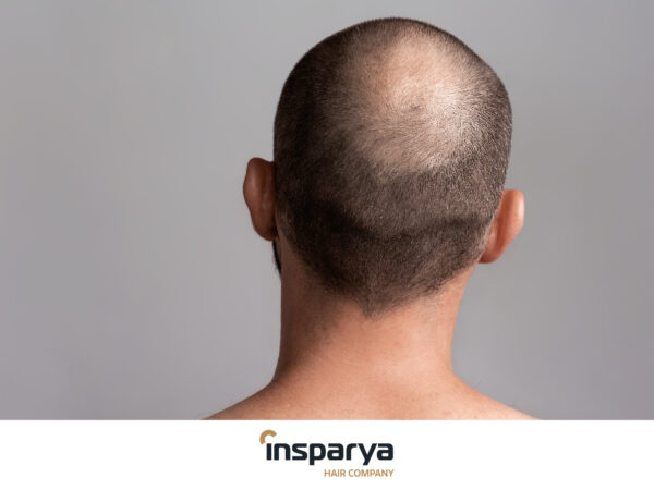 Come trattare l'alopecia sulla corona