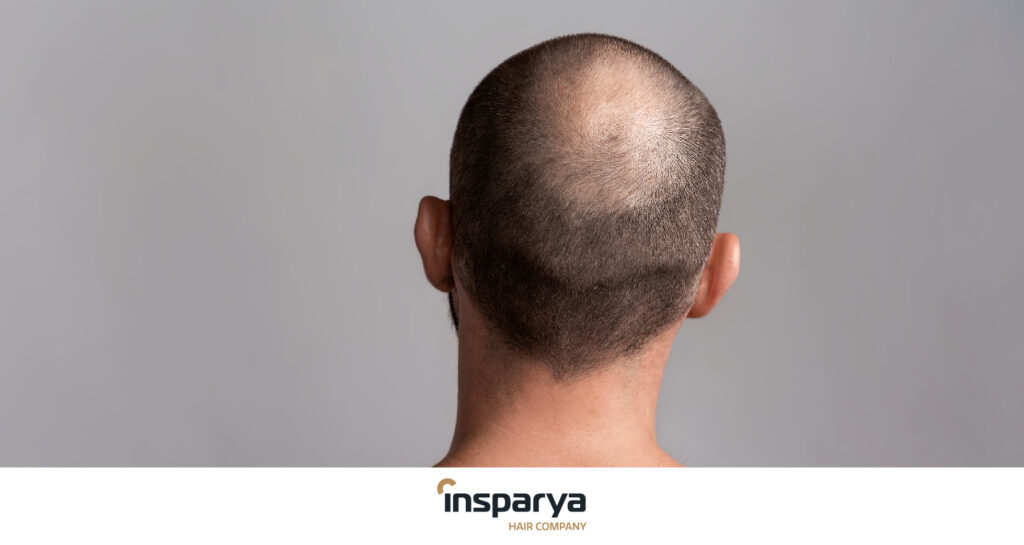 Che cos'è l'alopecia diffusa Cause, conseguenze e soluzioni