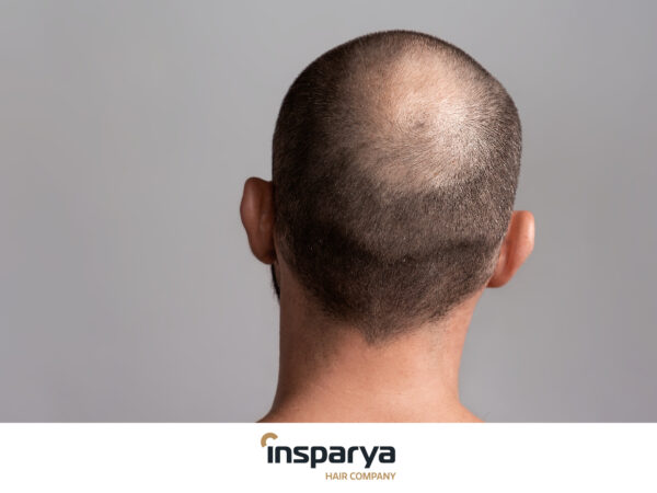 Che cos'è l'alopecia diffusa Cause, conseguenze e soluzioni
