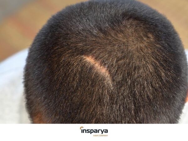 Alopecia Cicatriziale Sintomi e Cause - Insparya