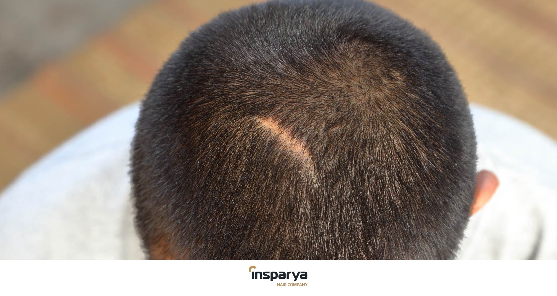 Alopecia Cicatriziale Sintomi e Cause - Insparya